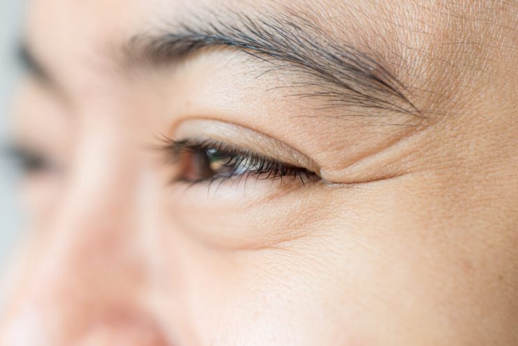 Woman with eye wrinkles