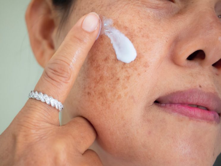 woman applying cream